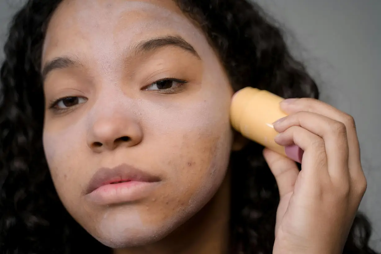 problèmes de peau noire hyperpigmentation acne